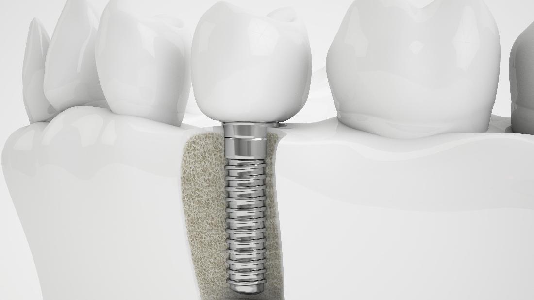 Dental Implants Milwaukee WI Preparing for Your Dental Implant