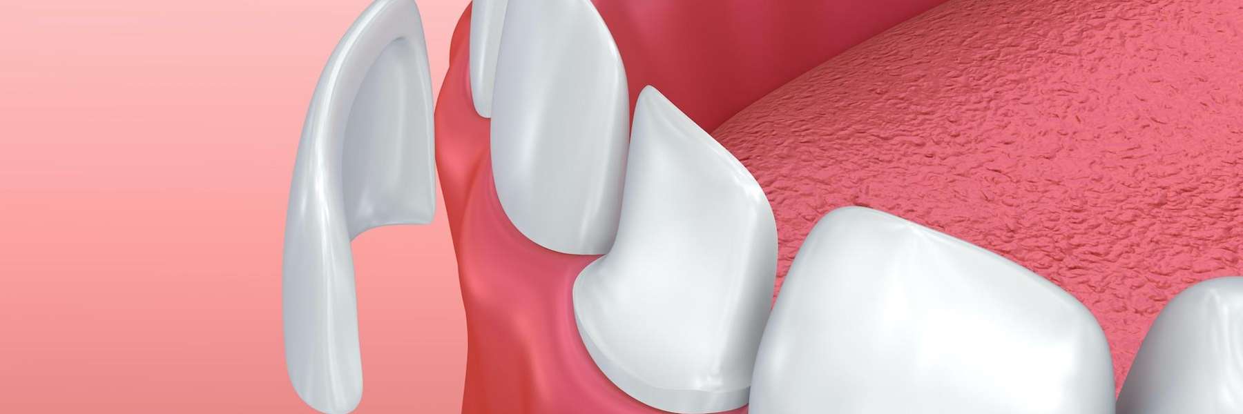 An illustration of veneers in West Allis, WI.