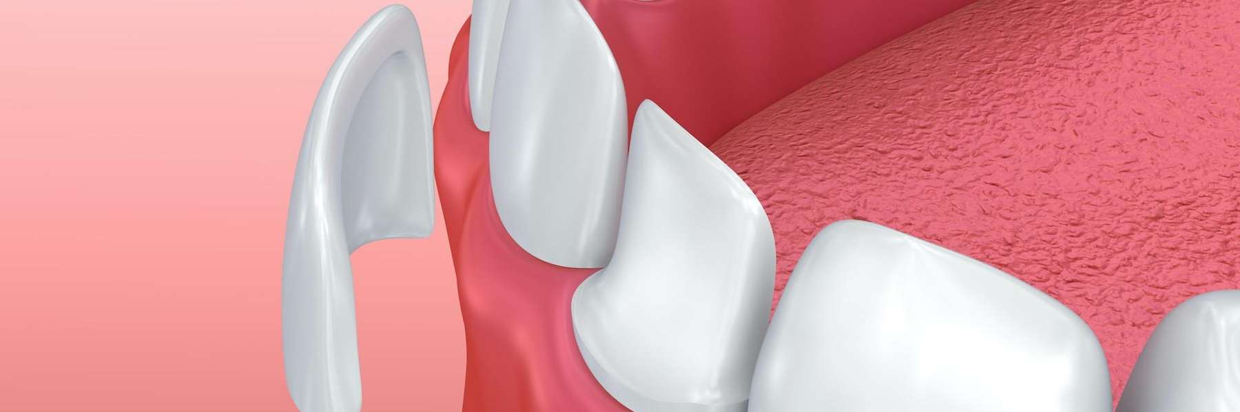 Dental Veneers in West Allis, WI