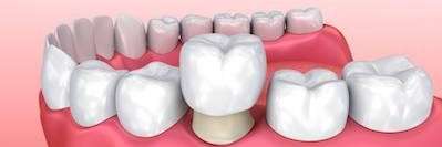 Same-Day Crowns Last in Milwaukee, WI