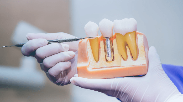 A Dental Implant model in West Allis, WI
