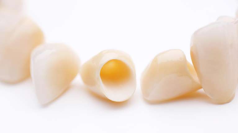 An illustration of dental crown at Wisconsin, Milwaukee