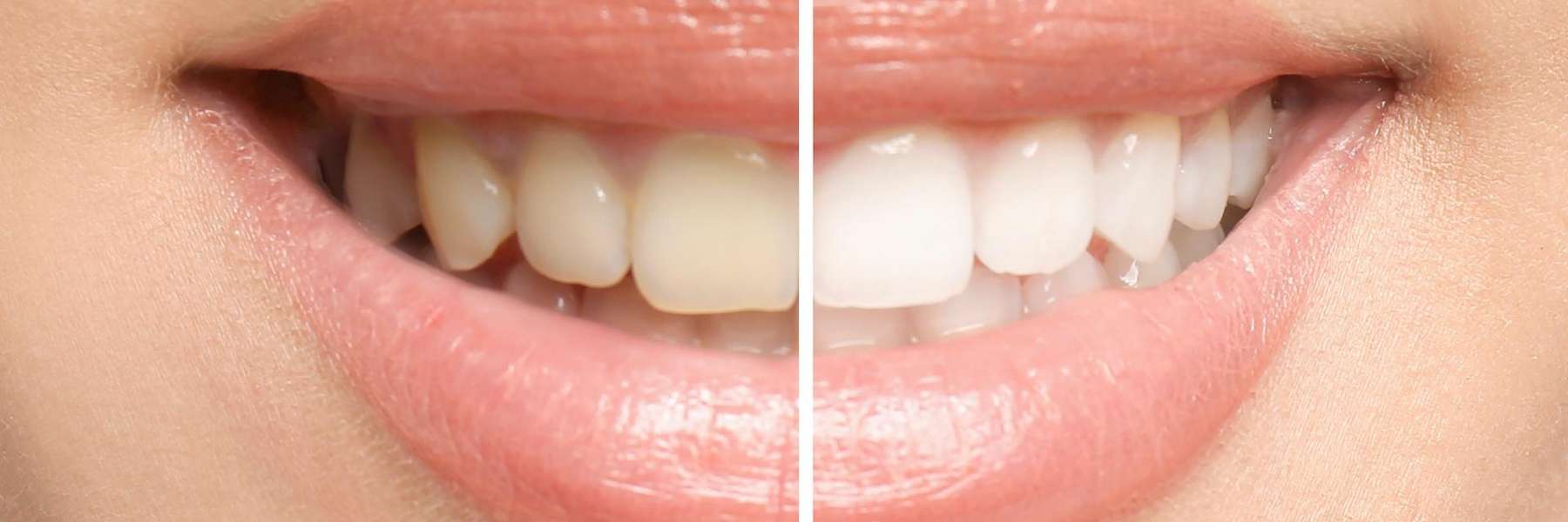 A picture of teeth before and after whitening in Milwaukee, WI.