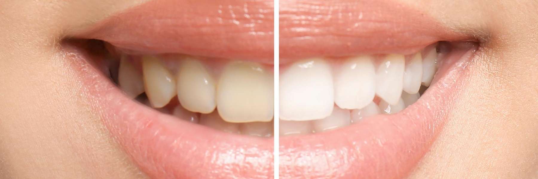 A side by side Teeth whitening result in Milwaukee, WI