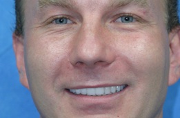 Smile Makeover used to transform man's smile | Dentist West Allis WI