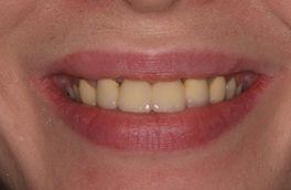 Dental Bridge | Wisconsin Smiles | Milwaukee