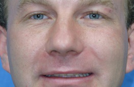 Man with misaligned smile | WisconsinSmiles