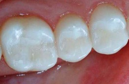 Tooth-colored fillings in back teeth | WisconsinSmiles