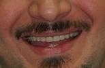 dentures | wisconsin smiles | west allis