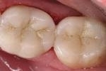 new tooth-colored dental crowns