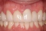 Dental Veneers | Wisconsin Smiles | West Allis