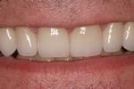 Veneers | Wisconsin Smiles | Milwaukee