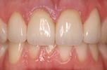 Veneers | Wisconsin Smiles | West Allis