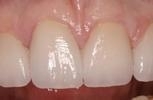 Smile Makeover | Wisconsin Smiles | West Allis