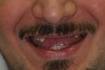 dentures | wisconsin smiles | west allis