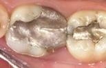 old silver dental crowns