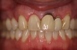 Dental Crowns | Wisconsin Smiles | Milwaukee