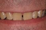 Porcelain Veneers | Wisconsin Smiles | West Allis