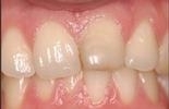porcelain veneers| Wisconsin Smiles | Milwaukee