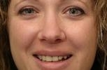 veneers | wisconsin smiles | west allis
