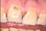 Smile Makeover | Wisconsin Smiles | West Allis