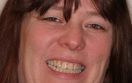 Woman with uneven and discolored teeth | Dentist Milwaukee WI