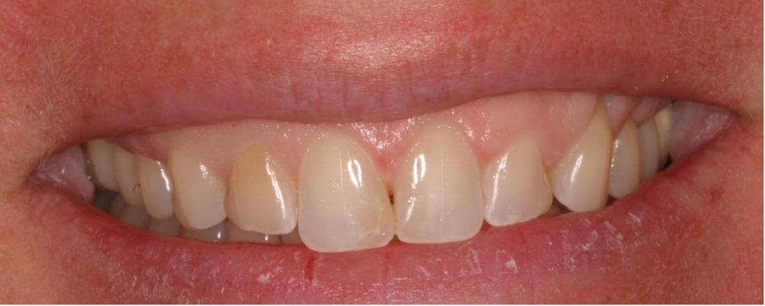 Discolored Teeth | Dentist Milwaukee WI