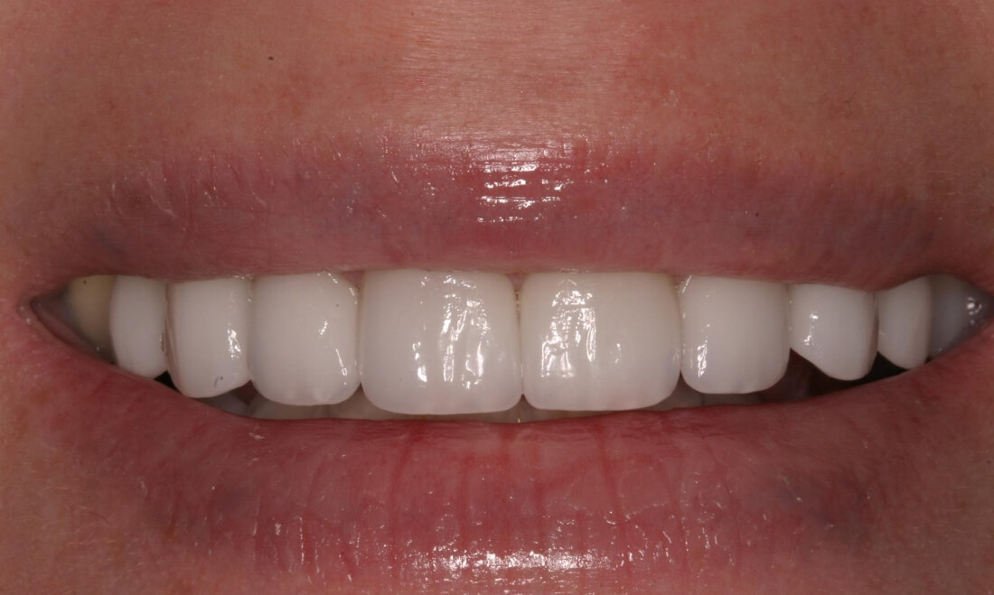 whitened and transformed smile