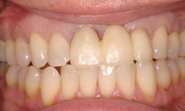 Discolored Teeth | Dentist Milwaukee WI