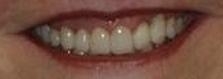 New white and straight teeth | Dentist Milwaukee WI
