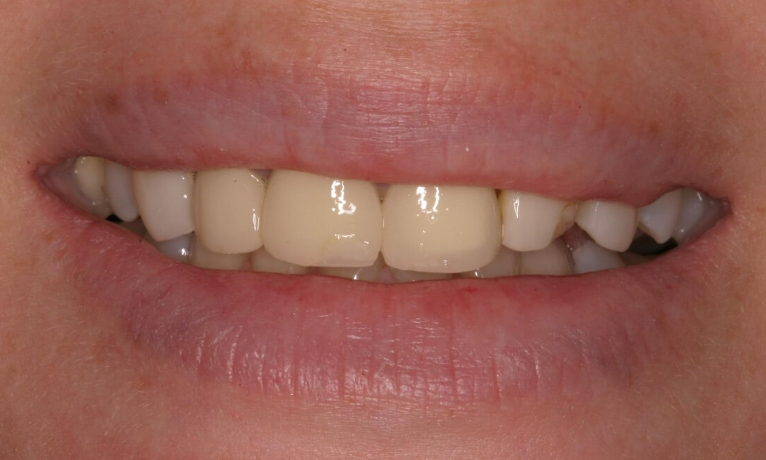 Discolored and crooked teeth | Dentist Milwaukee WI