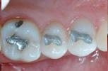 Old silver fillings in back teeth | Dentist Milwaukee WI