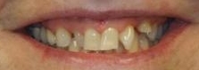 Crooked and discolored teeth | WisconsinSmiles