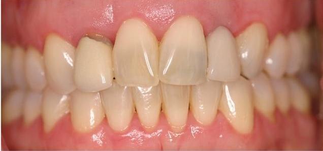 Discolored Teeth | Dentist West Allis WI