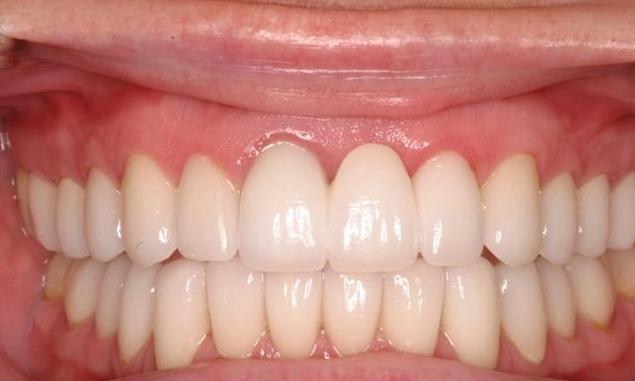 Close Up of Whitened Teeth | Dentist Milwaukee WI
