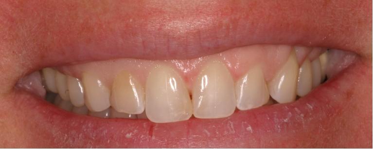 Smile-5-Before-Image